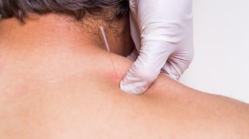 dry needling